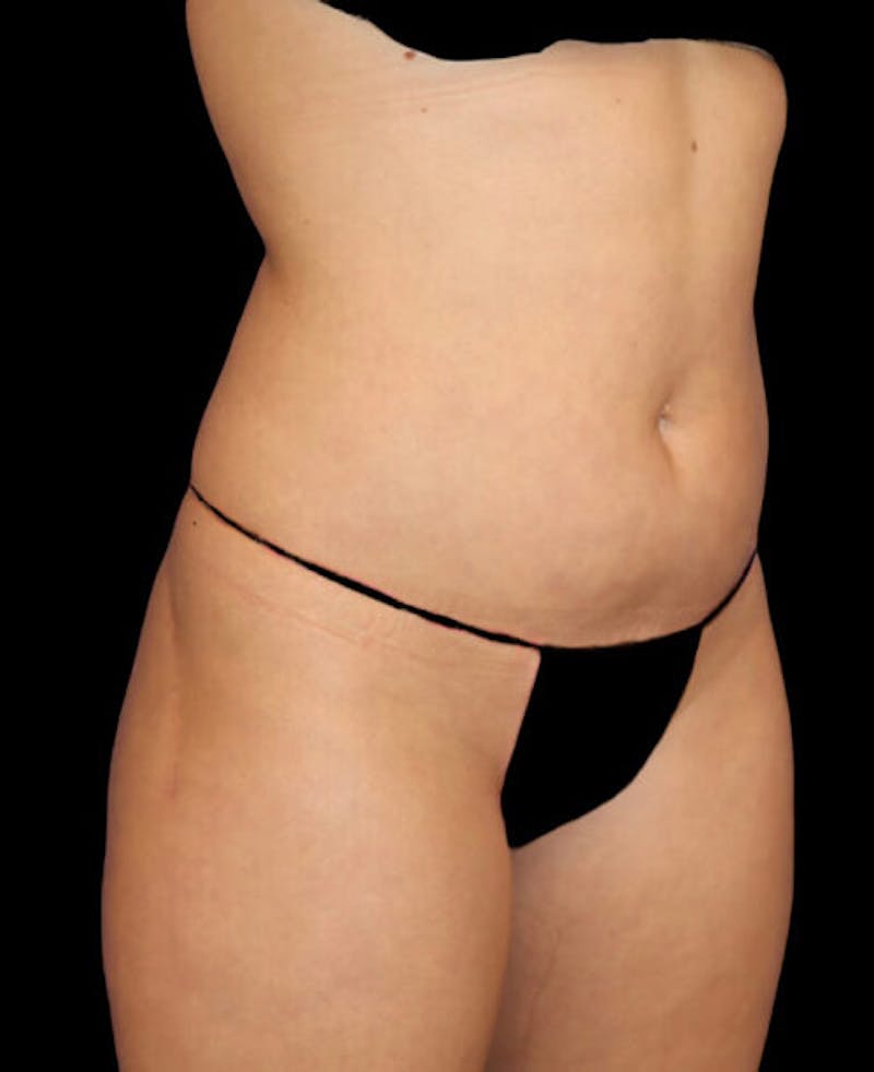 Liposuction Before & After Gallery - Patient 209778 - Image 3