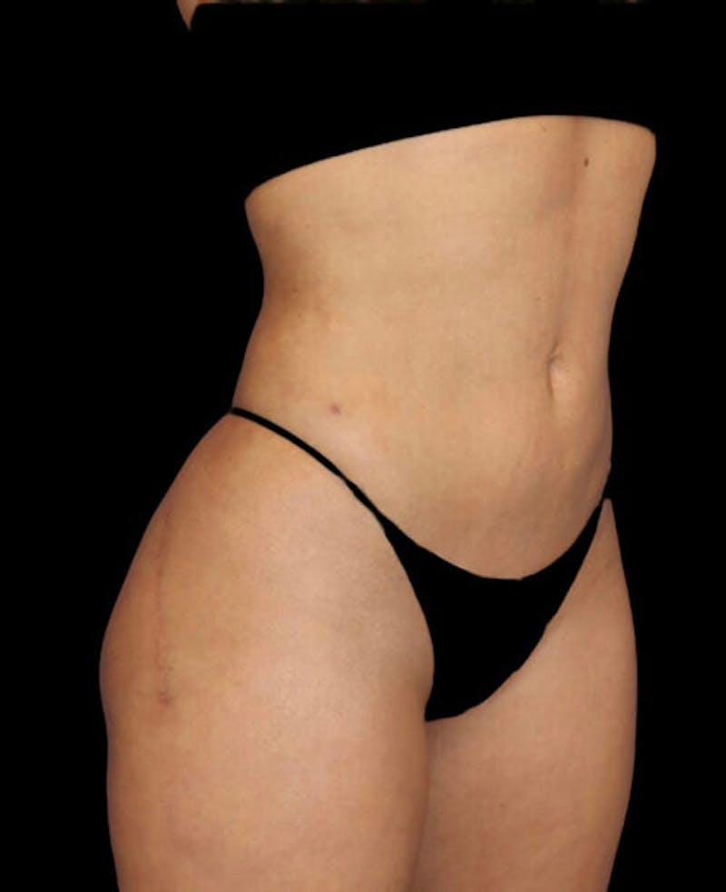 Liposuction Before & After Gallery - Patient 209778 - Image 4