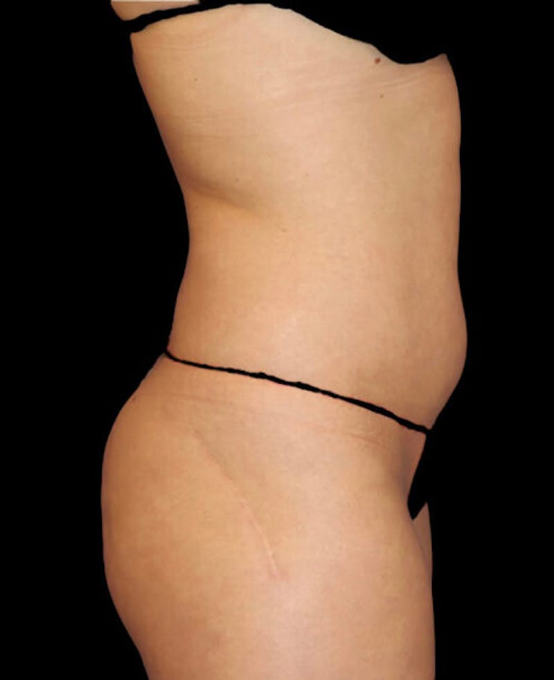 Liposuction Before & After Gallery - Patient 209778 - Image 5