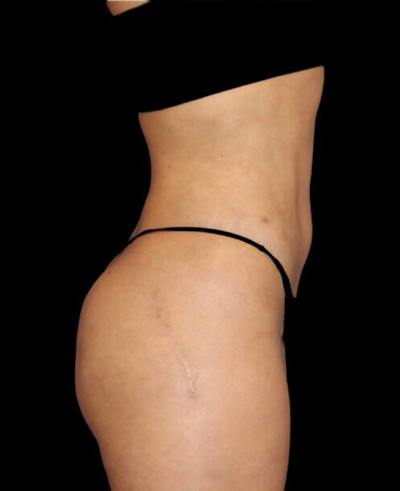Liposuction Before & After Gallery - Patient 209778 - Image 6