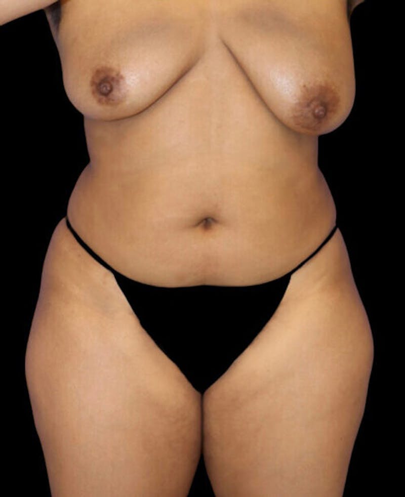 Liposuction Before & After Gallery - Patient 324875 - Image 1