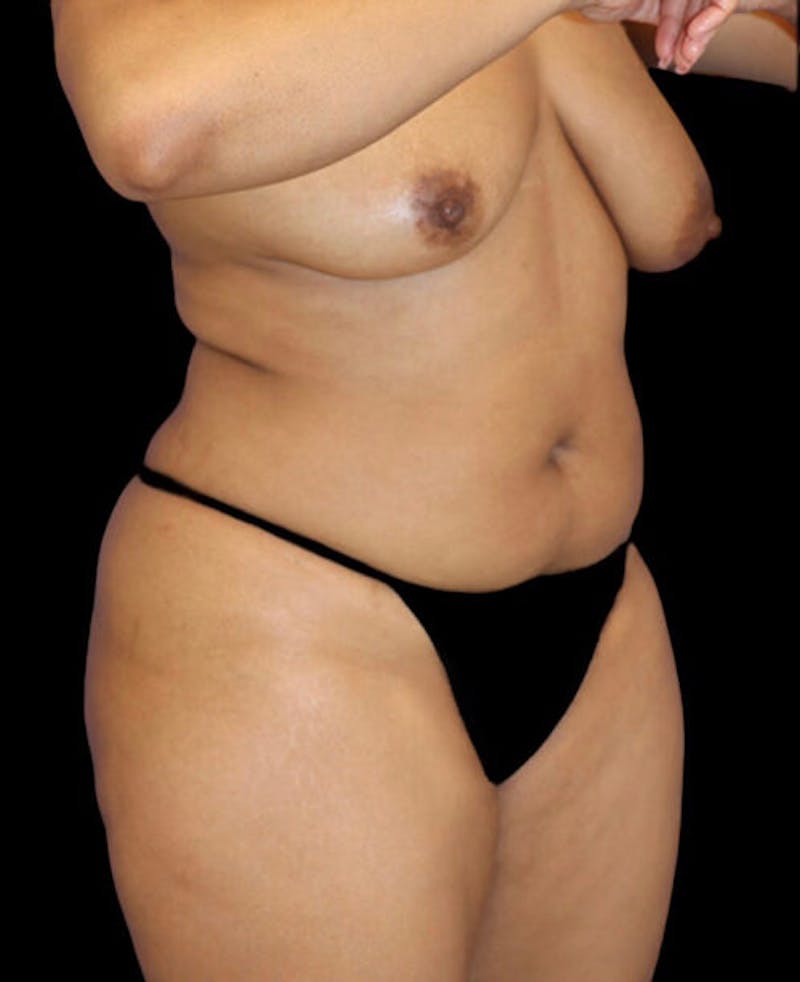 Liposuction Before & After Gallery - Patient 324875 - Image 3