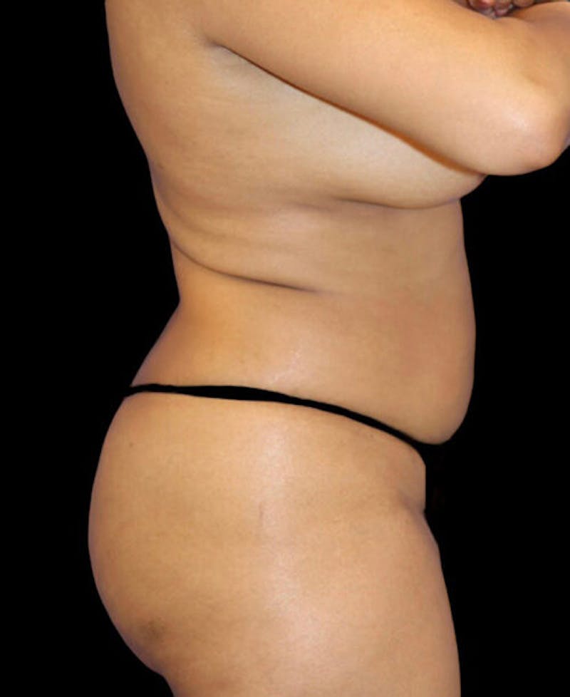 Liposuction Before & After Gallery - Patient 324875 - Image 5