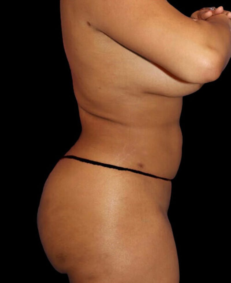 Liposuction Before & After Gallery - Patient 324875 - Image 6