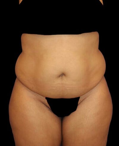 Liposuction Before & After Gallery - Patient 255404 - Image 1