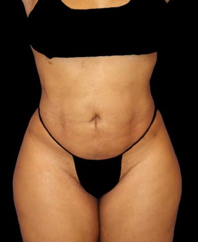Liposuction Before & After Gallery - Patient 255404 - Image 2