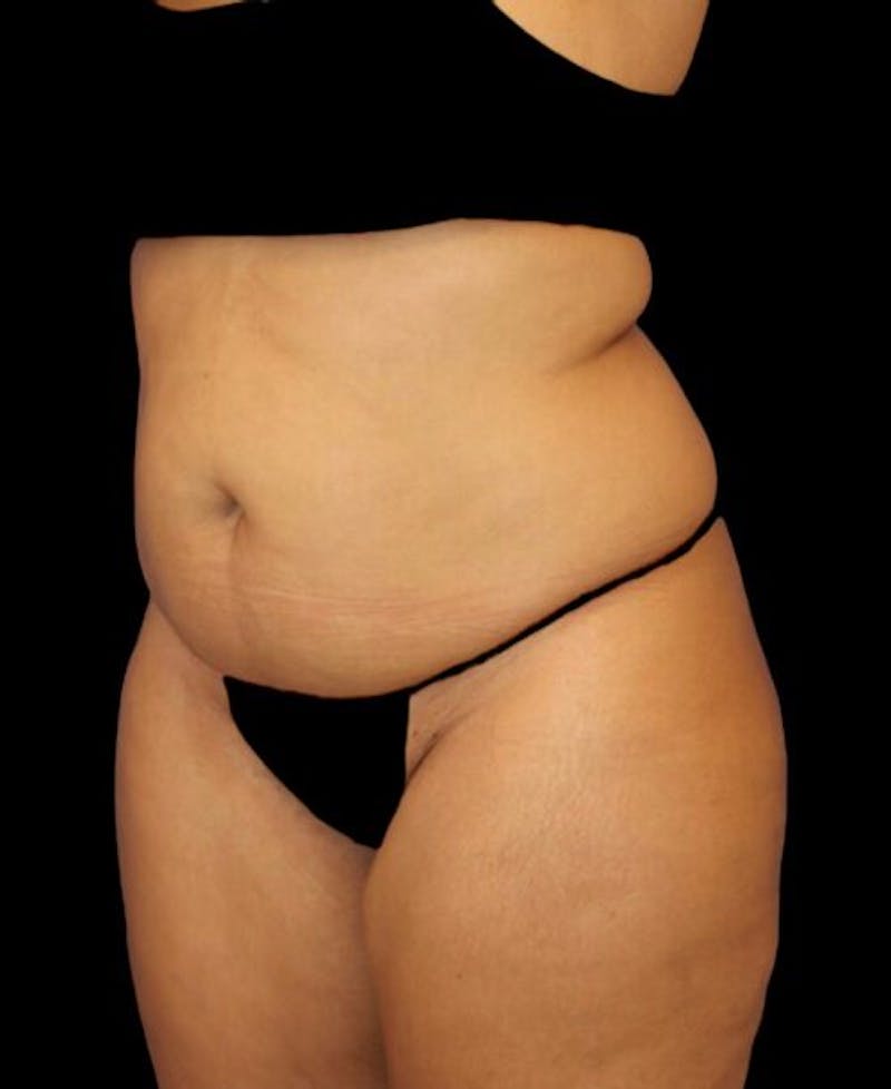Liposuction Before & After Gallery - Patient 255404 - Image 3
