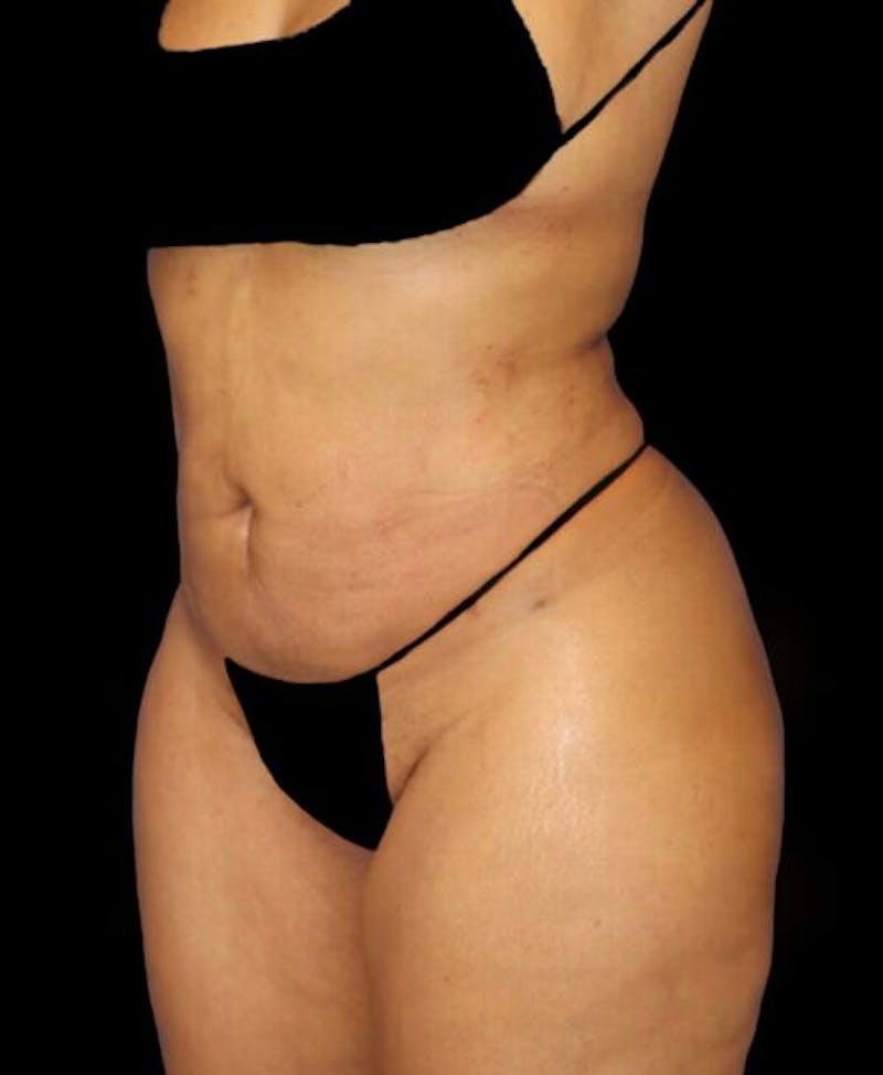 Liposuction Before & After Gallery - Patient 255404 - Image 4