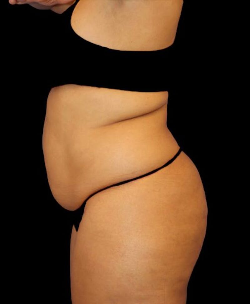 Liposuction Before & After Gallery - Patient 255404 - Image 5