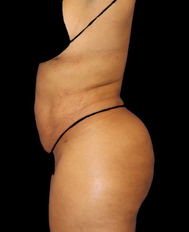 Liposuction Before & After Gallery - Patient 255404 - Image 6