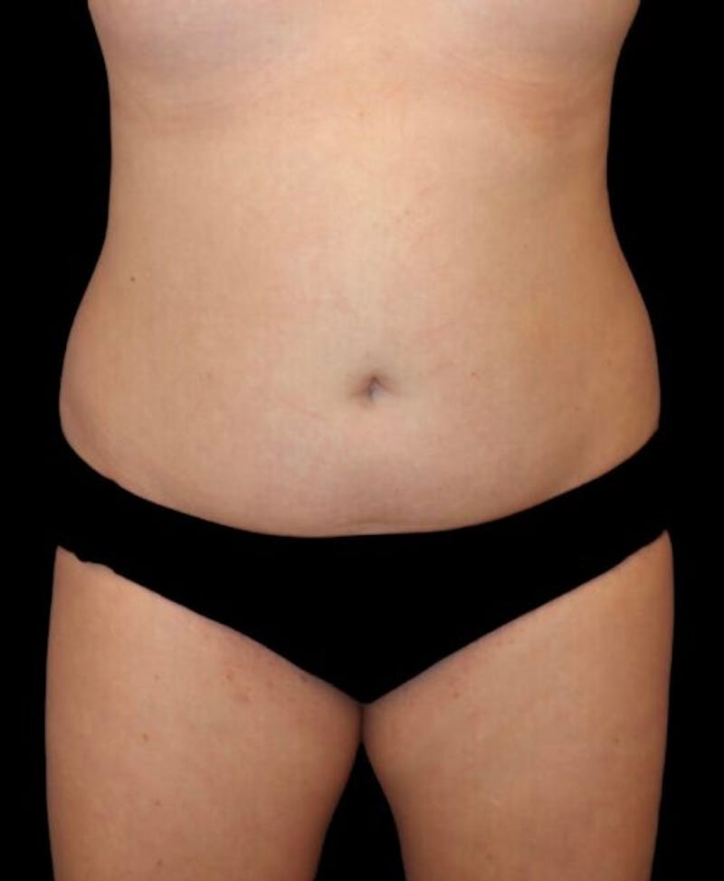 Liposuction Before & After Gallery - Patient 151188 - Image 1