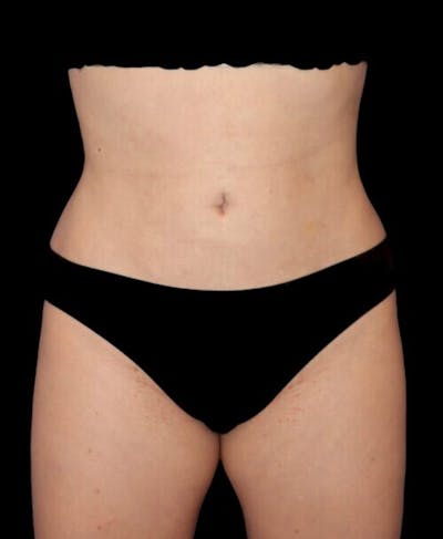 Liposuction Before & After Gallery - Patient 151188 - Image 2