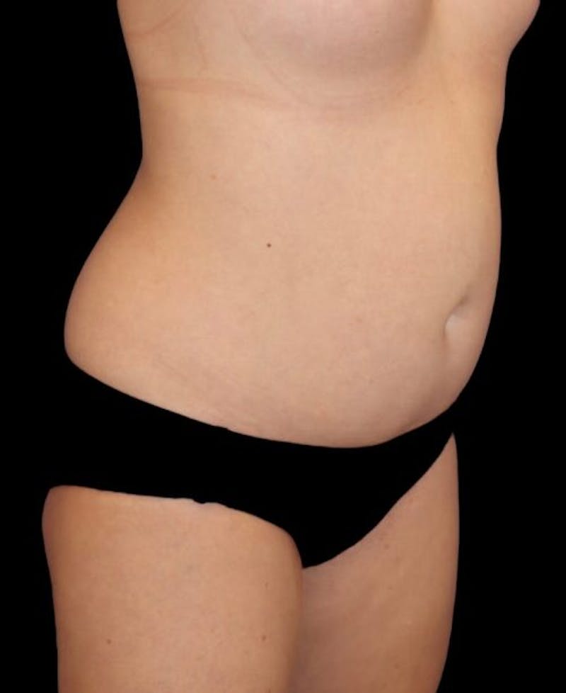 Liposuction Before & After Gallery - Patient 151188 - Image 3