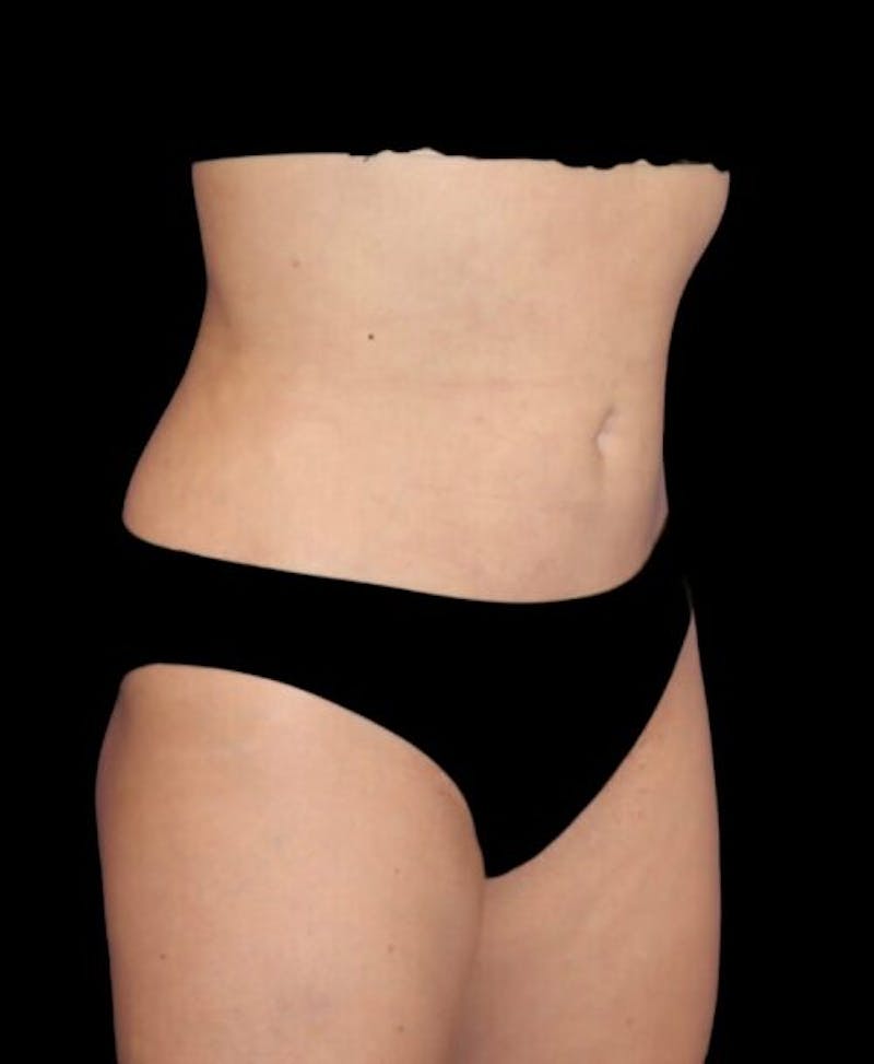 Liposuction Before & After Gallery - Patient 151188 - Image 4