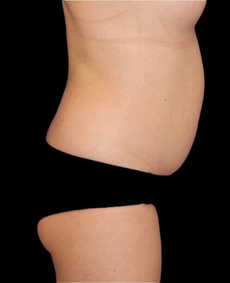 Liposuction Before & After Gallery - Patient 151188 - Image 5