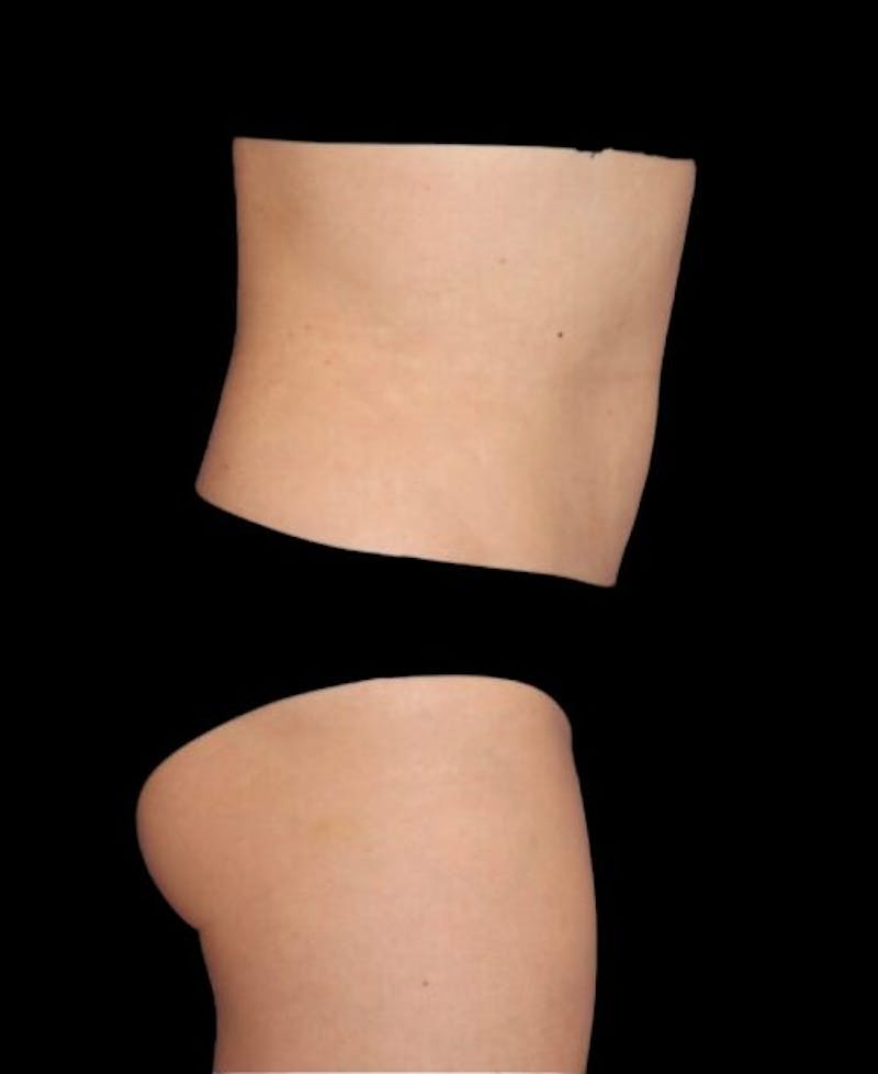 Liposuction Before & After Gallery - Patient 151188 - Image 6