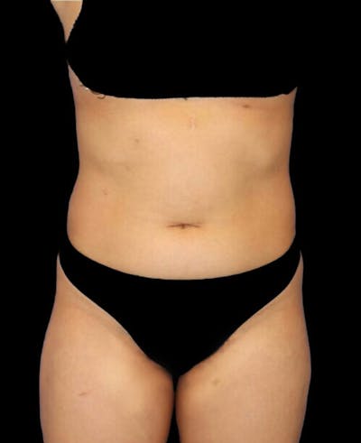 Liposuction Before & After Gallery - Patient 273222 - Image 1
