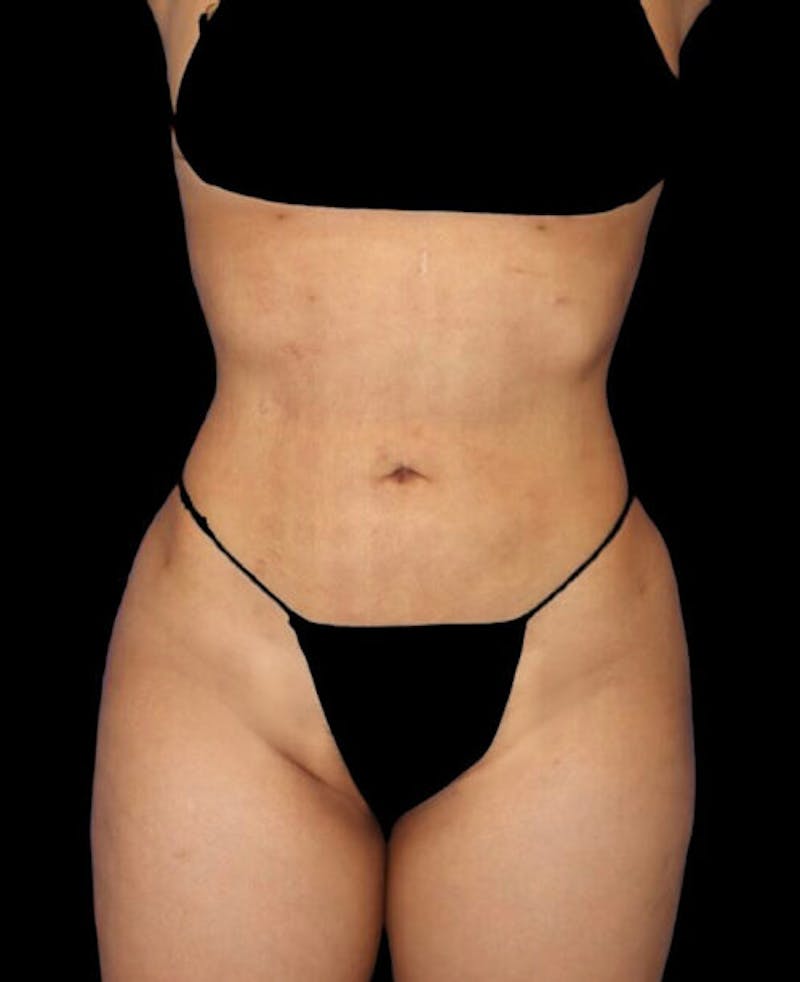 Liposuction Before & After Gallery - Patient 273222 - Image 2