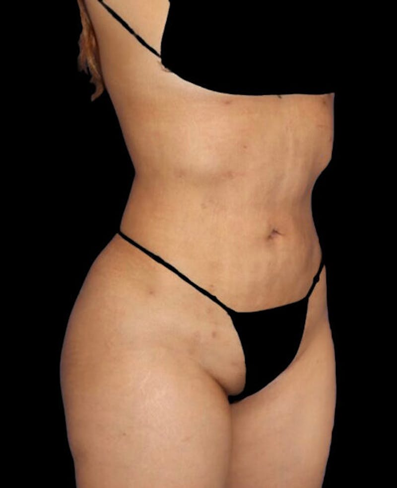 Liposuction Before & After Gallery - Patient 273222 - Image 4