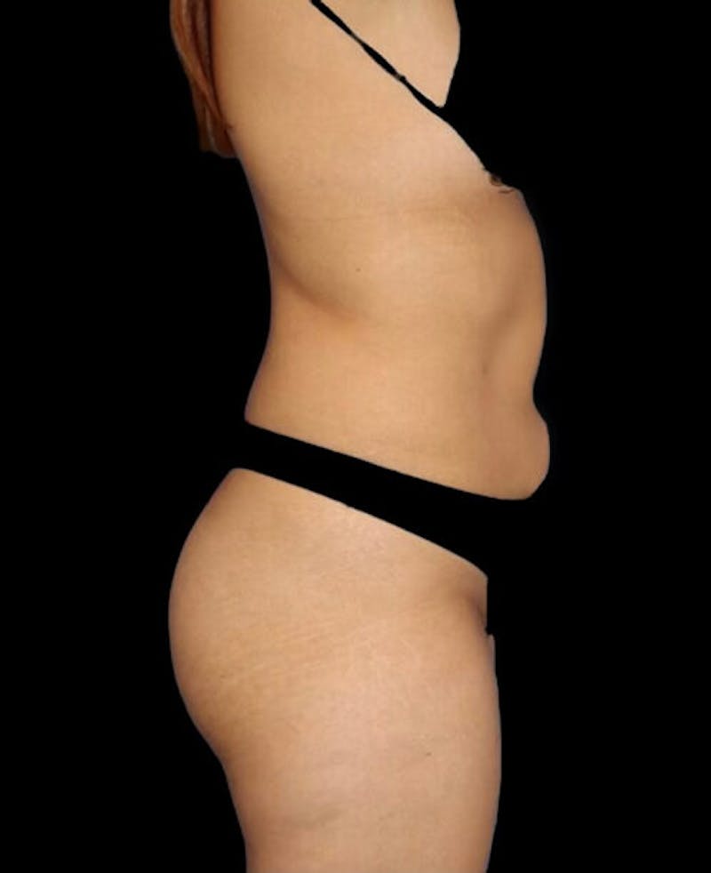Liposuction Before & After Gallery - Patient 273222 - Image 5
