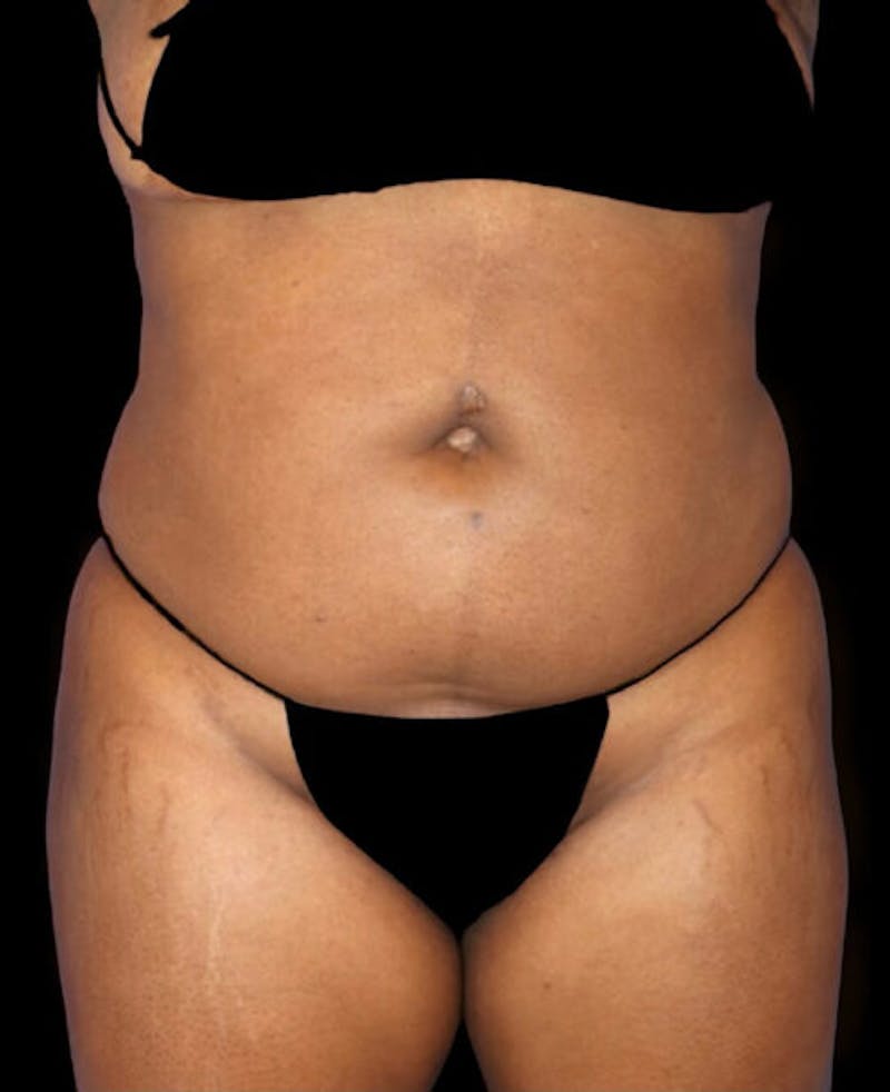 Liposuction Before & After Gallery - Patient 139701 - Image 1