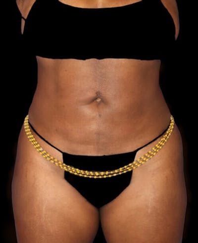 Liposuction Before & After Gallery - Patient 139701 - Image 2