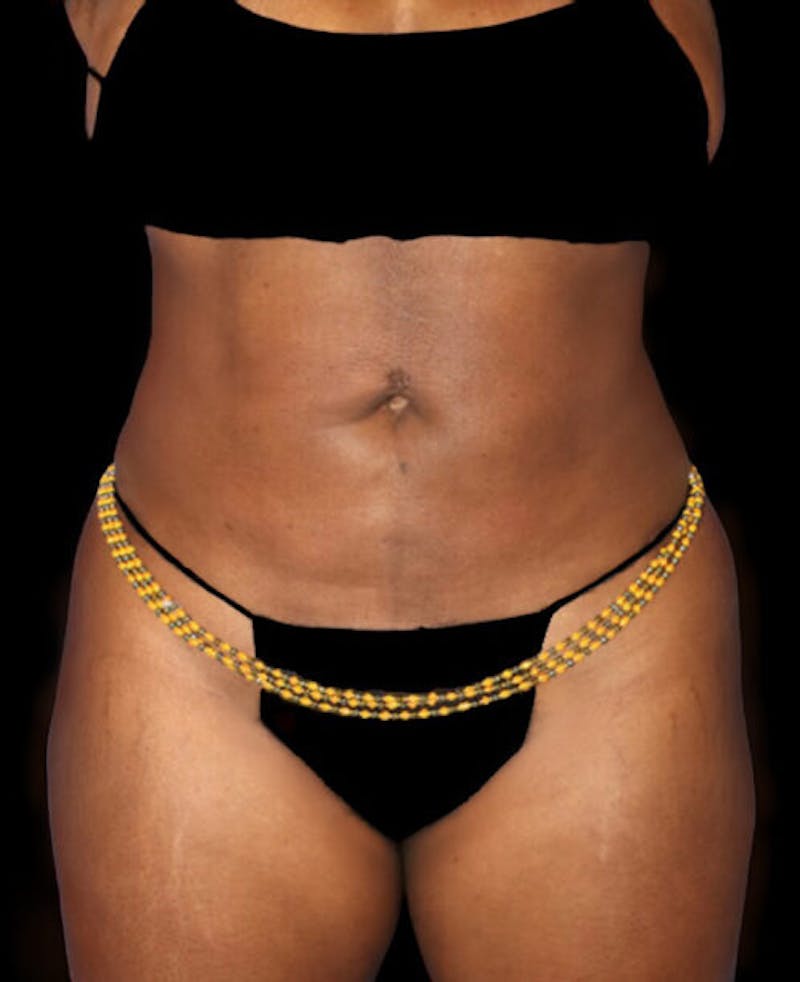 Liposuction Before & After Gallery - Patient 139701 - Image 2