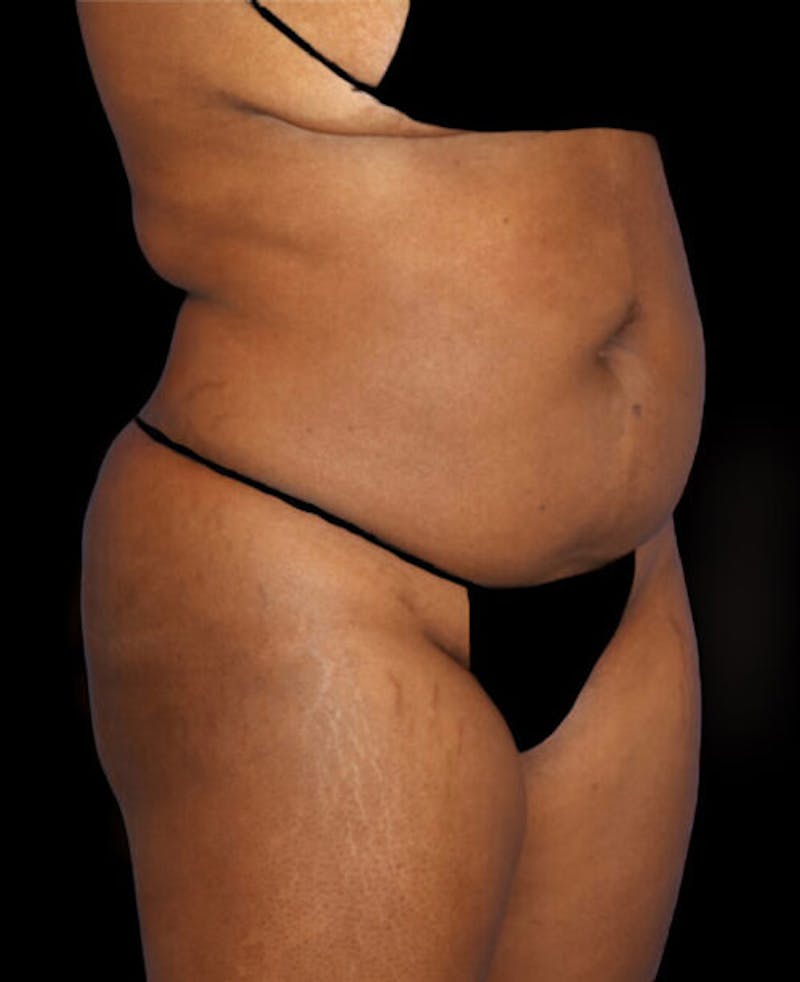 Liposuction Before & After Gallery - Patient 139701 - Image 3
