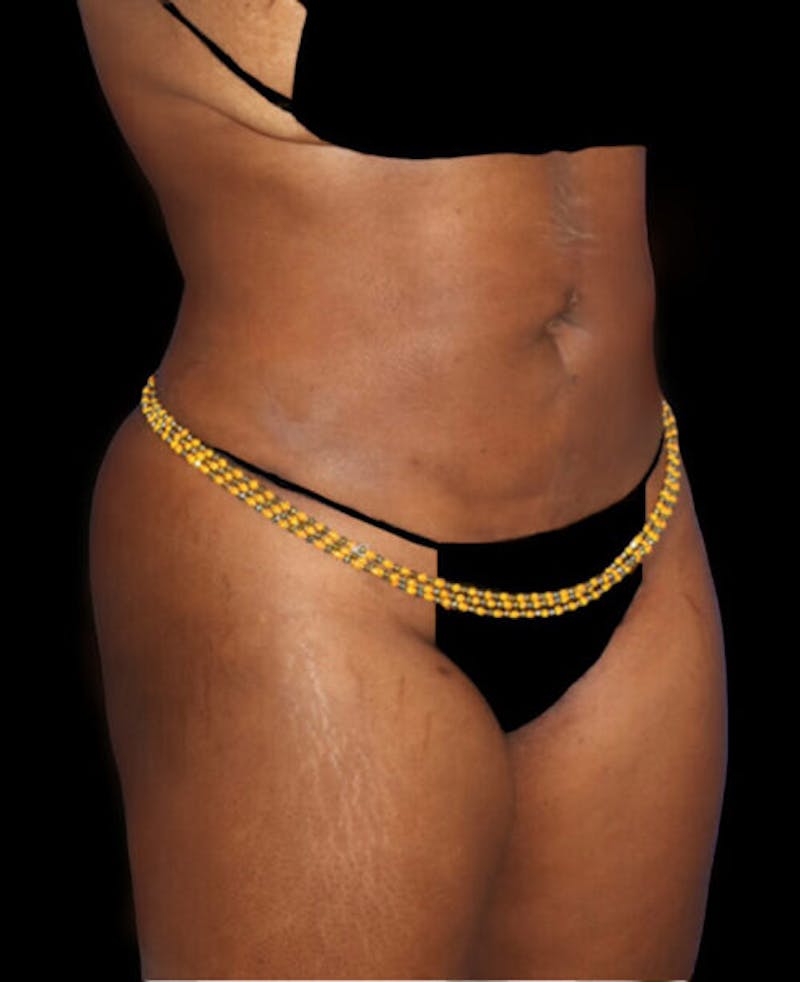 Liposuction Before & After Gallery - Patient 139701 - Image 4