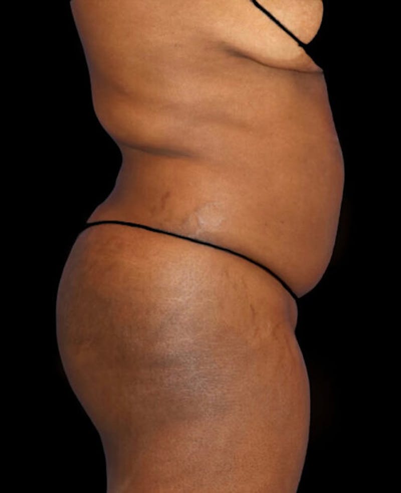 Liposuction Before & After Gallery - Patient 139701 - Image 5