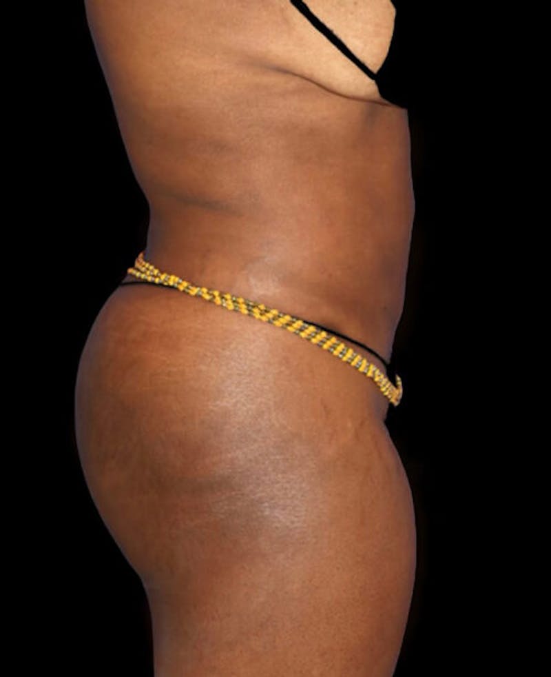 Liposuction Before & After Gallery - Patient 139701 - Image 6