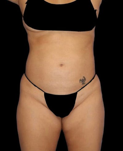 Liposuction Before & After Gallery - Patient 171692 - Image 1