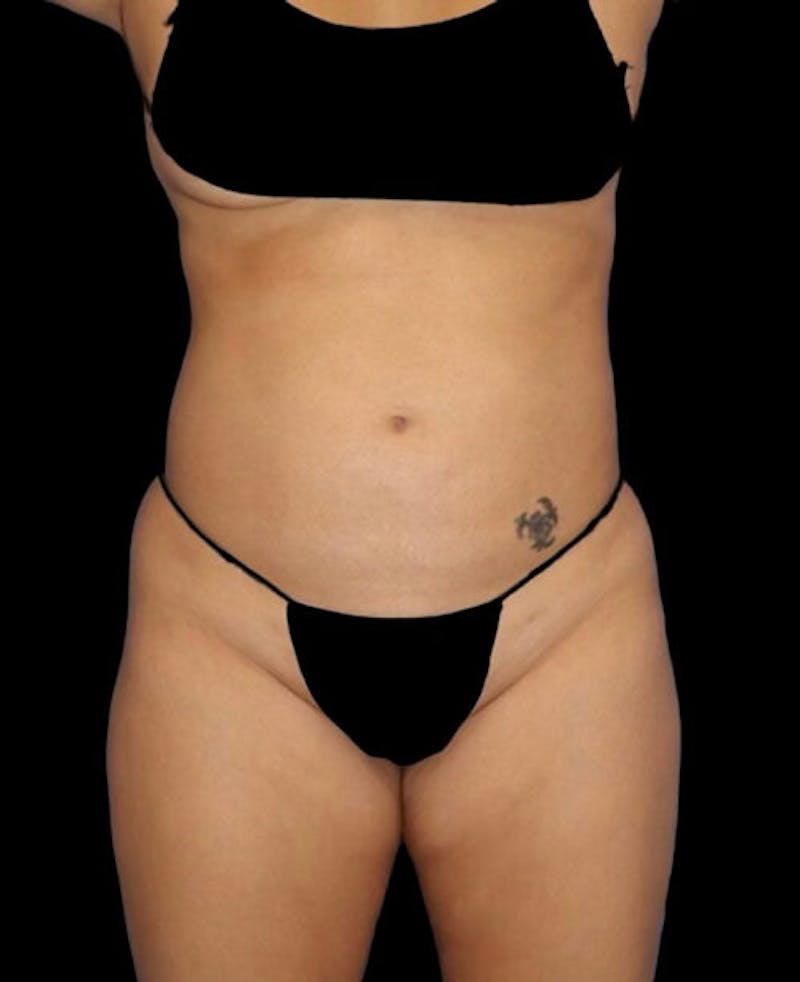 Liposuction Before & After Gallery - Patient 171692 - Image 1
