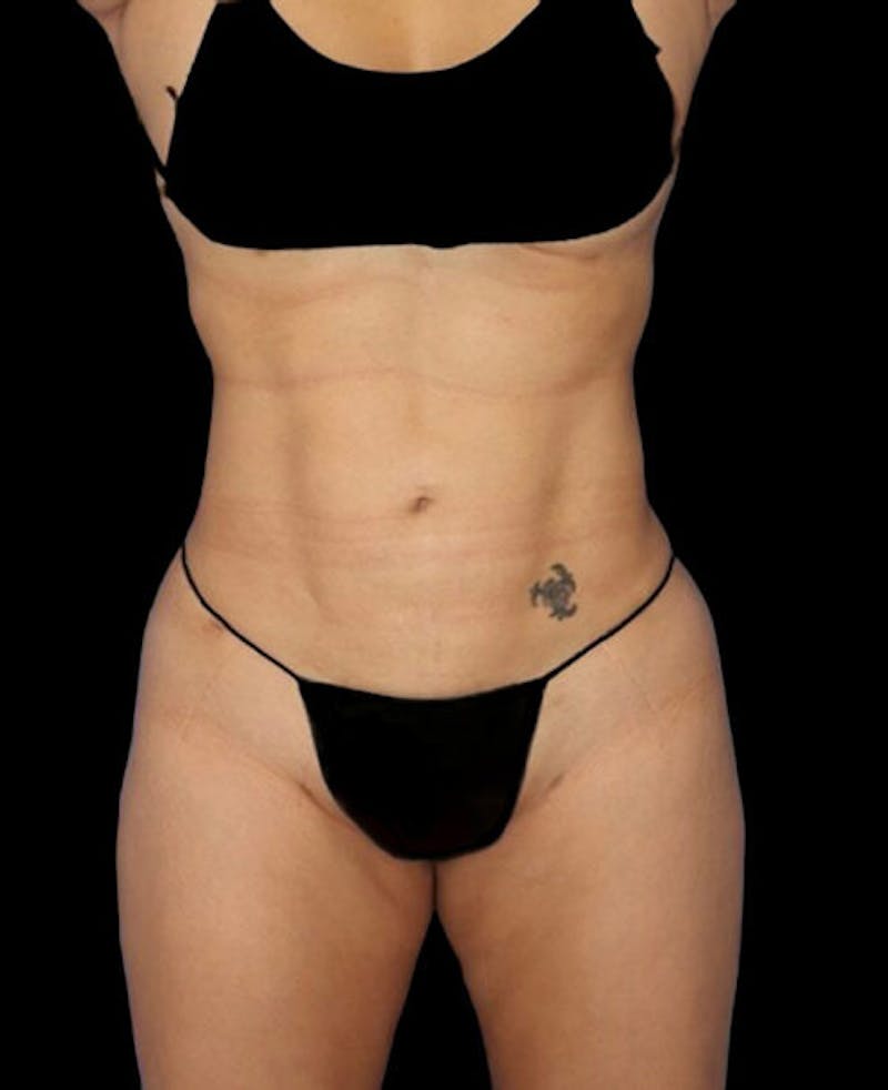 Liposuction Before & After Gallery - Patient 171692 - Image 2