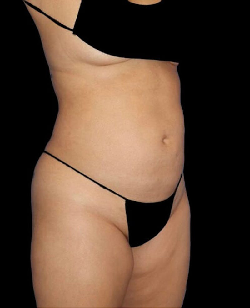 Liposuction Before & After Gallery - Patient 171692 - Image 3