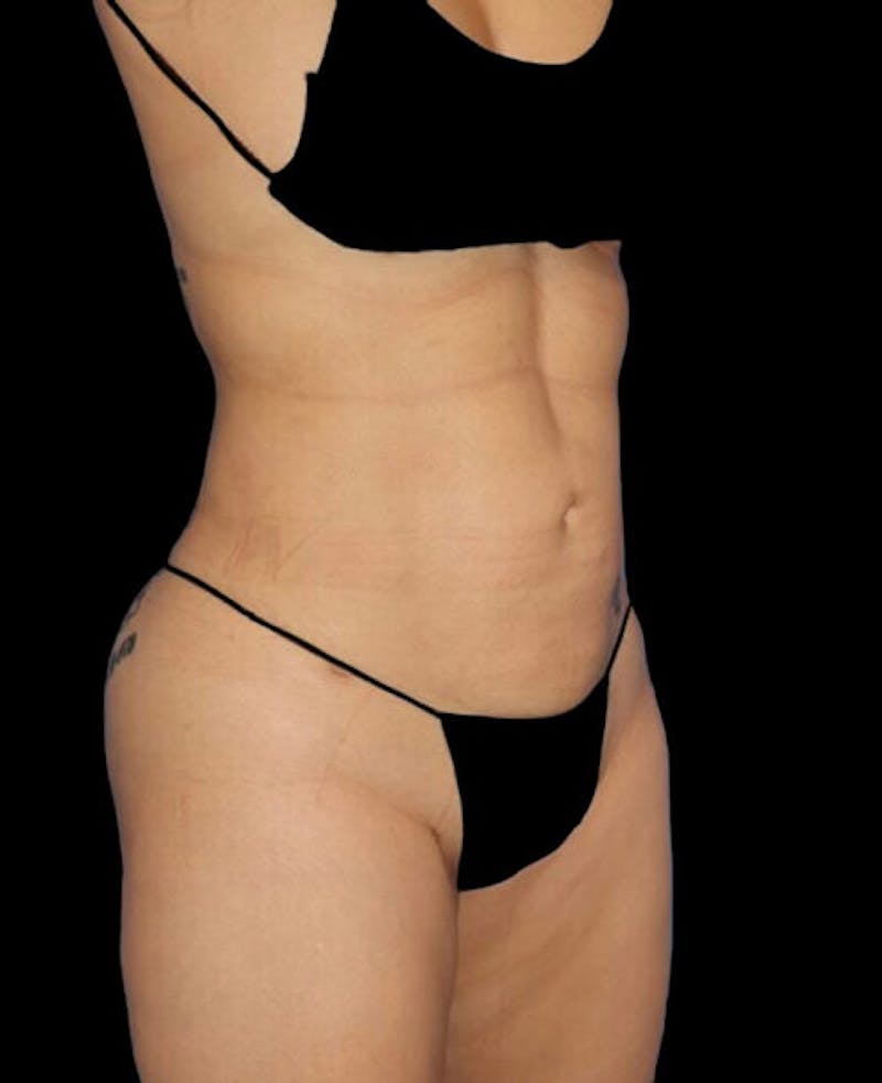 Liposuction Before & After Gallery - Patient 171692 - Image 4
