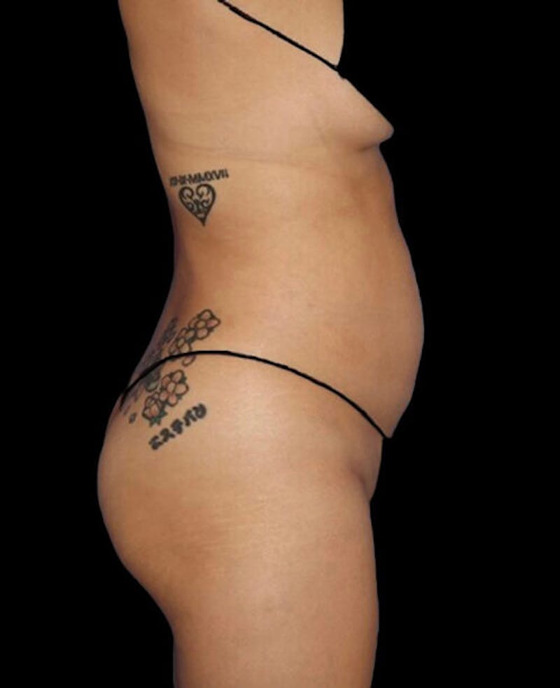 Liposuction Before & After Gallery - Patient 171692 - Image 5