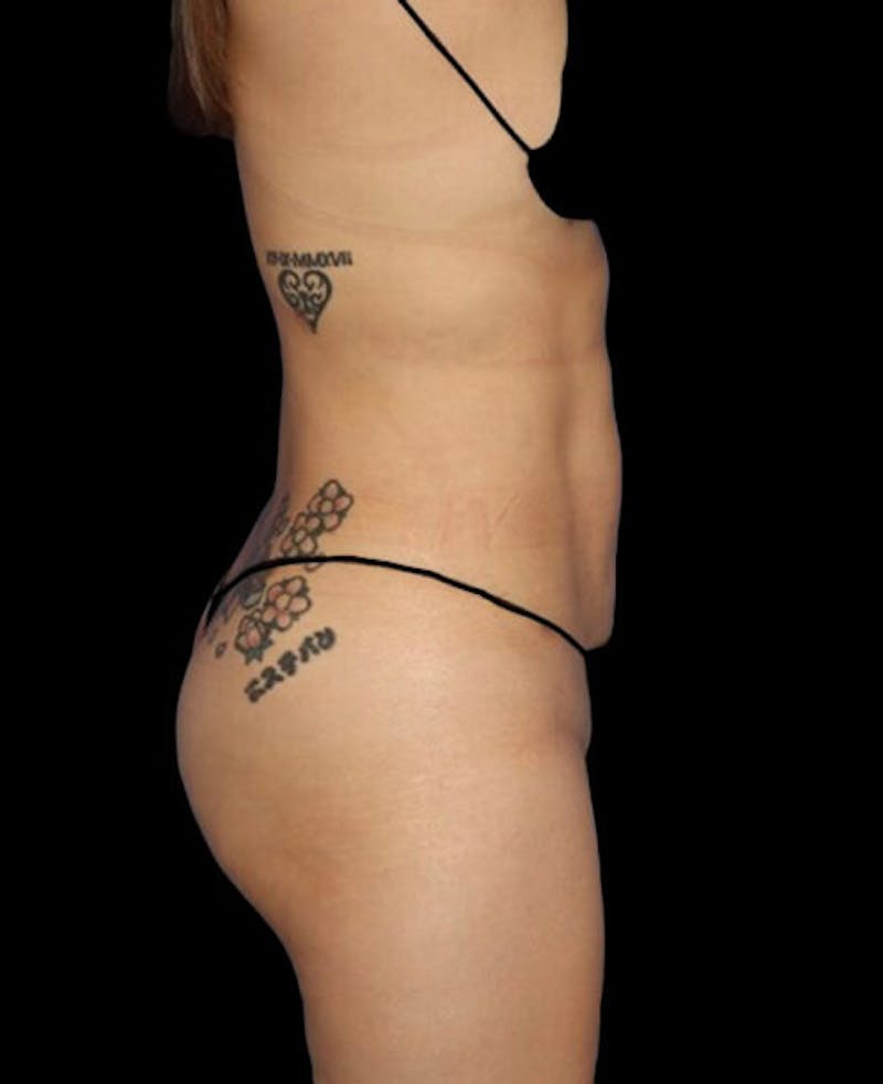 Liposuction Before & After Gallery - Patient 171692 - Image 6