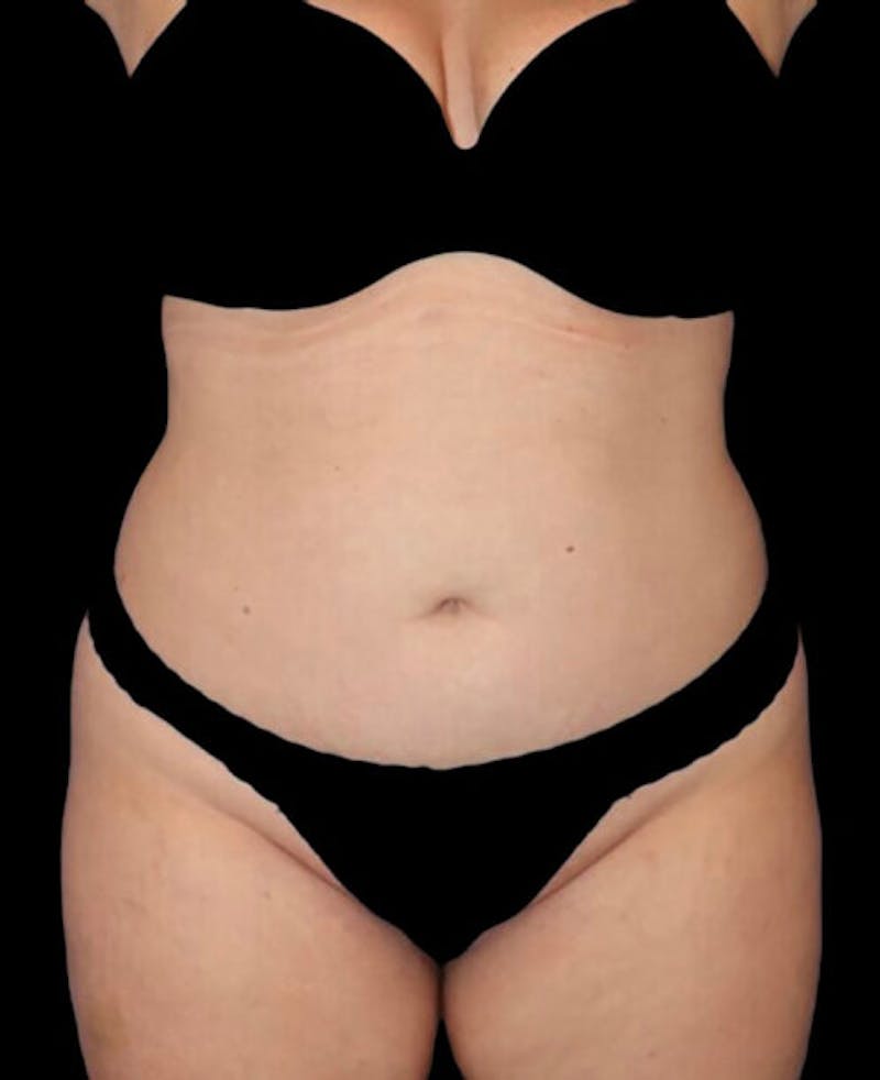 Liposuction Before & After Gallery - Patient 182976 - Image 1