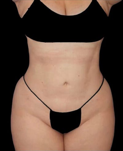 Liposuction Before & After Gallery - Patient 182976 - Image 2