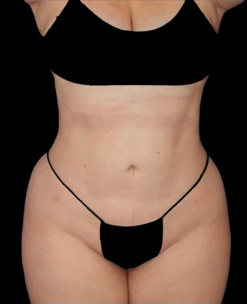 Liposuction Before & After Gallery - Patient 182976 - Image 2