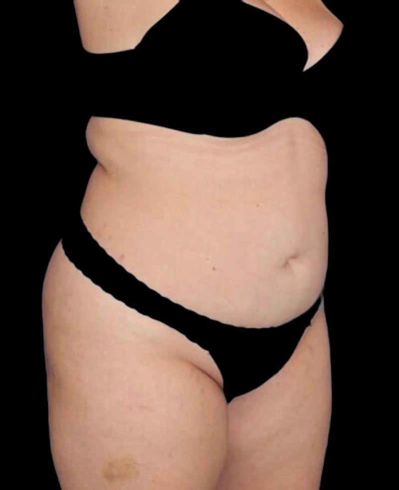 Liposuction Before & After Gallery - Patient 182976 - Image 3
