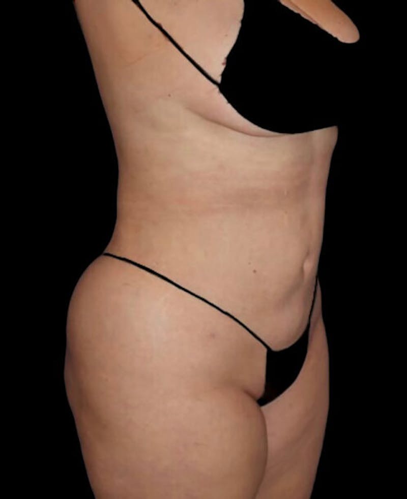 Liposuction Before & After Gallery - Patient 182976 - Image 4