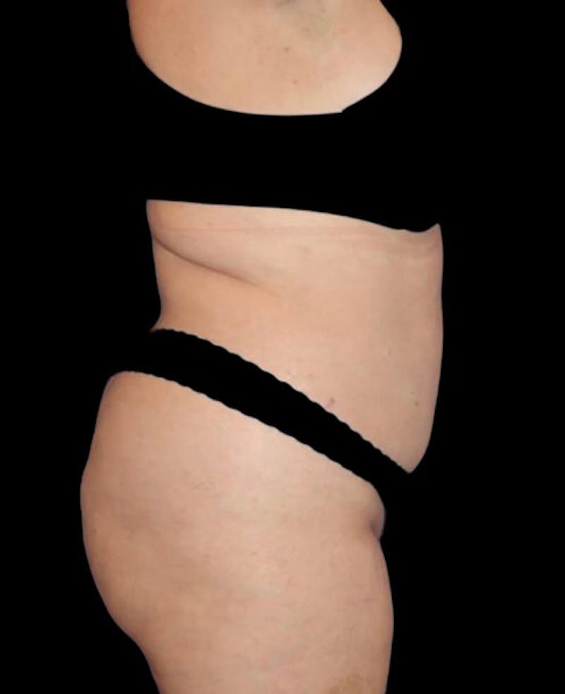 Liposuction Before & After Gallery - Patient 182976 - Image 5