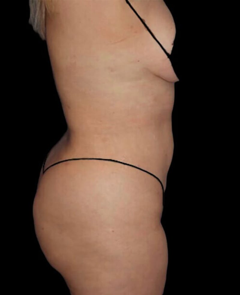 Liposuction Before & After Gallery - Patient 182976 - Image 6