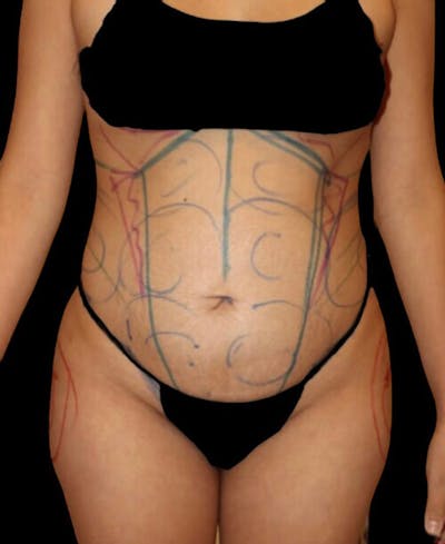 Liposuction Before & After Gallery - Patient 272395 - Image 1