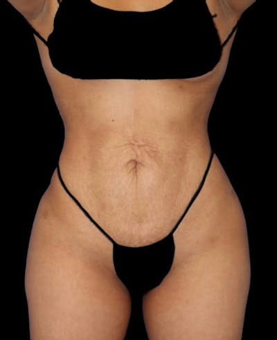 Liposuction Before & After Gallery - Patient 272395 - Image 2