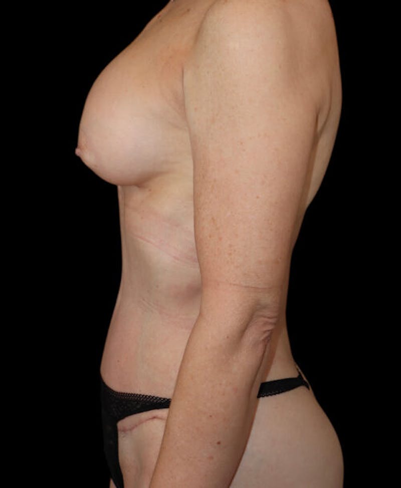 Mommy Makeover Before & After Gallery - Patient 180640 - Image 6