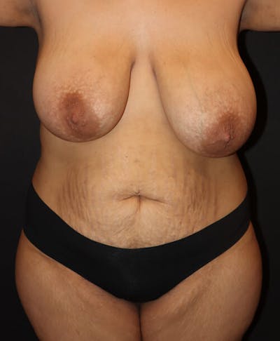 Mommy Makeover Before & After Gallery - Patient 386295 - Image 1