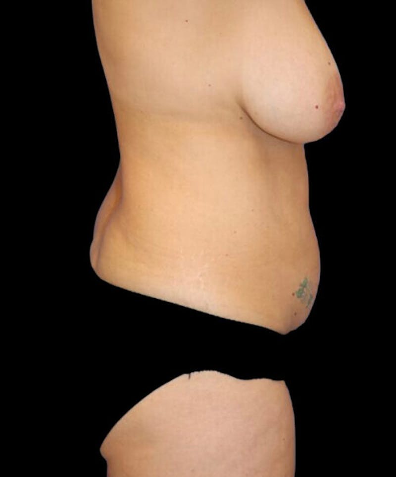 Mommy Makeover Before & After Gallery - Patient 234259 - Image 5